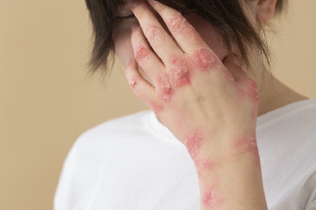 Sjogrens Syndrome And Scleroderma - HBGMC