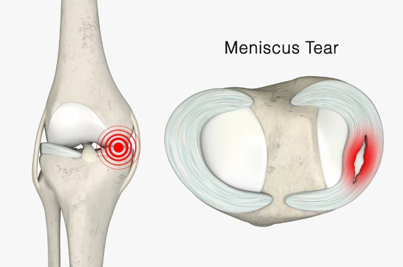 Knee Pain | Dubai | DHCC | HBGMC