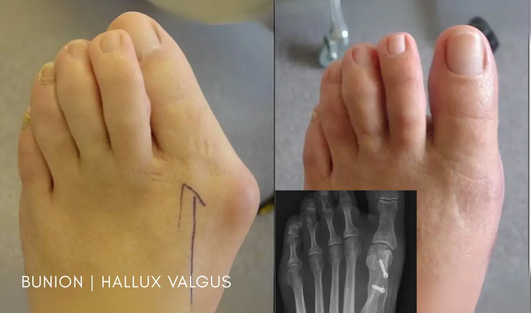Bunion Hallux Valgus - HBGMC