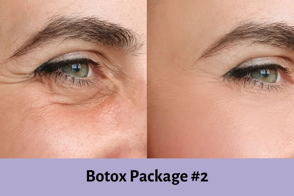 Botox Package - HBGMC