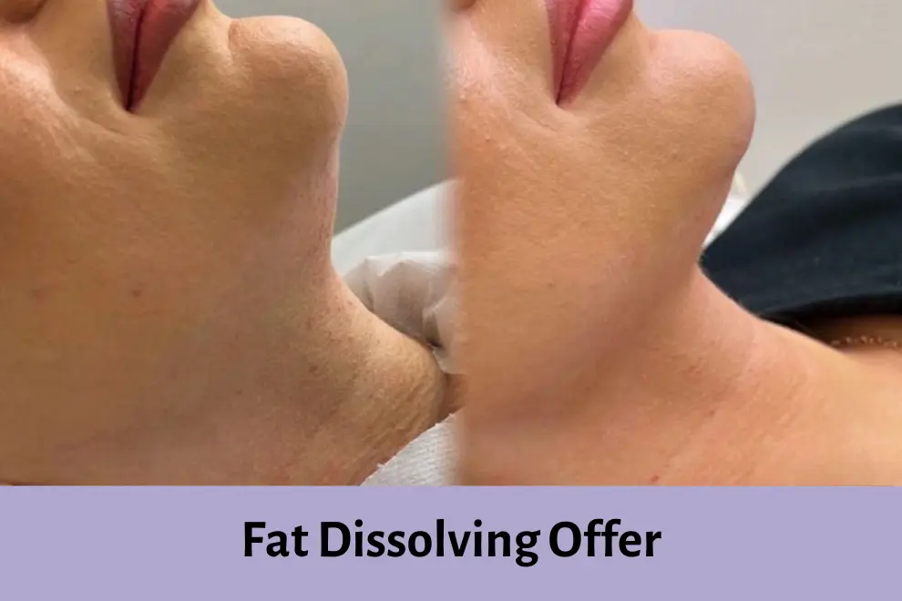Fat Dissolving Offer - HBGMC