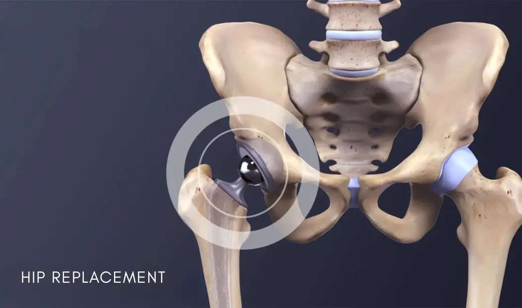 Hip Replacement - HBGMC