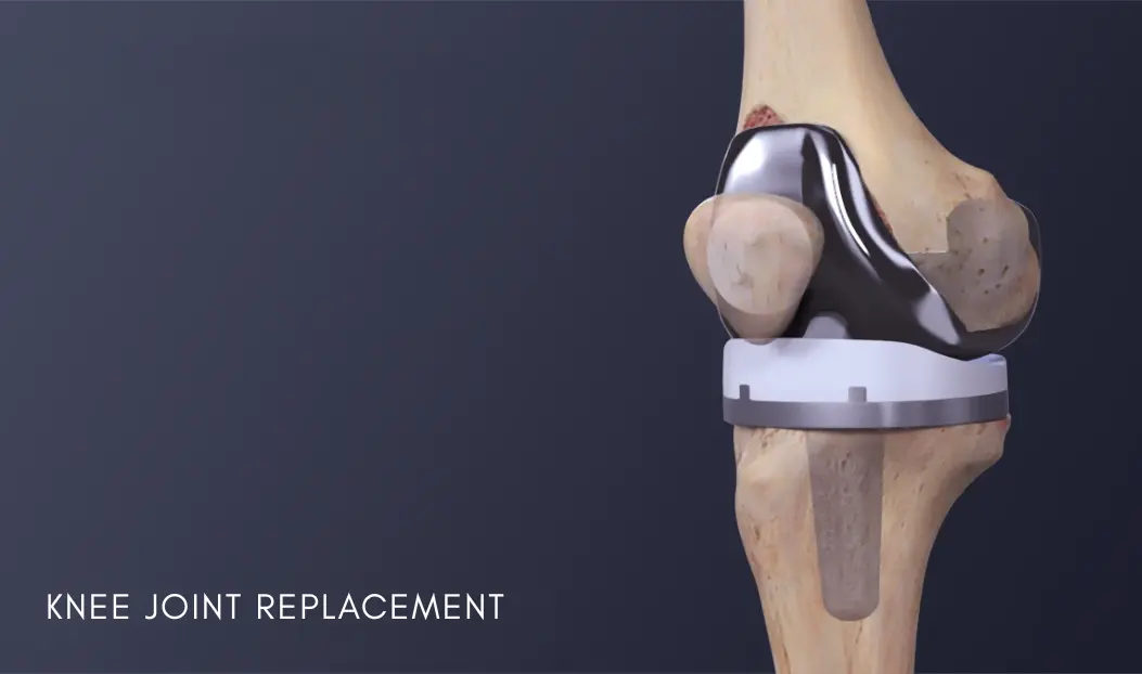 Knee Joint Replacement - HBGMC