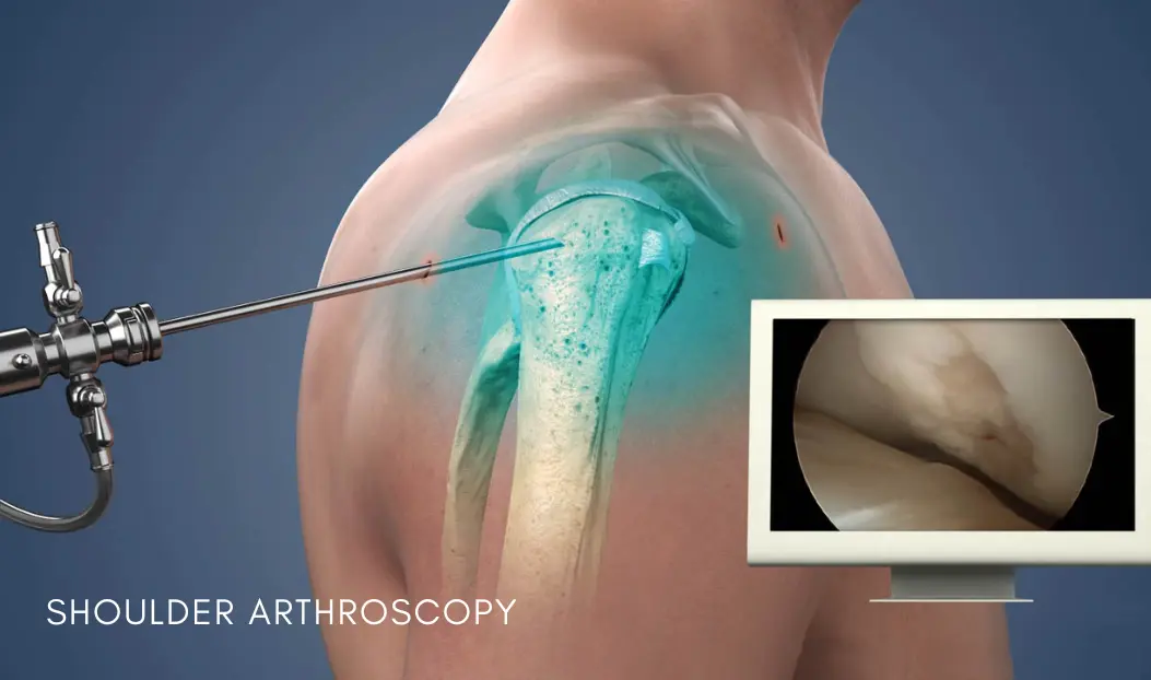 Shoulder Replacement - HBGMC