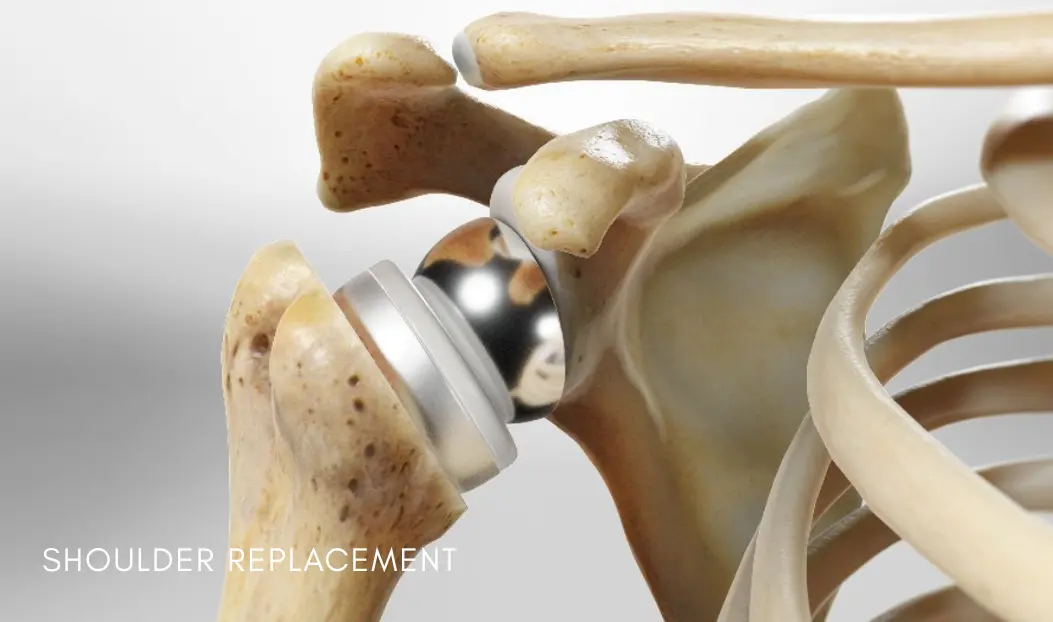 Shoulder Replacement - HBGMC